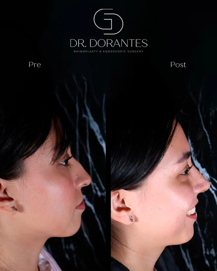 Caso real — Rinoplastia