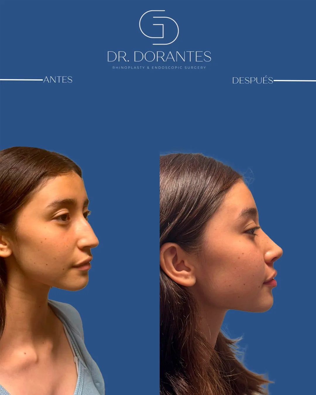 Caso real — Rinoplastia