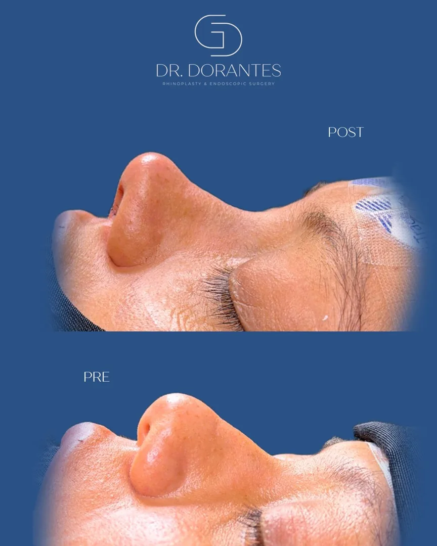 Caso real — Rinoplastia